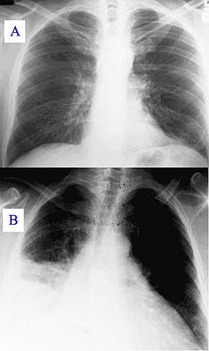 Archivo:Pneumonia x-ray