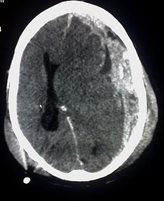 Trauma subdural.jpg