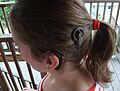 Cochlear implant2