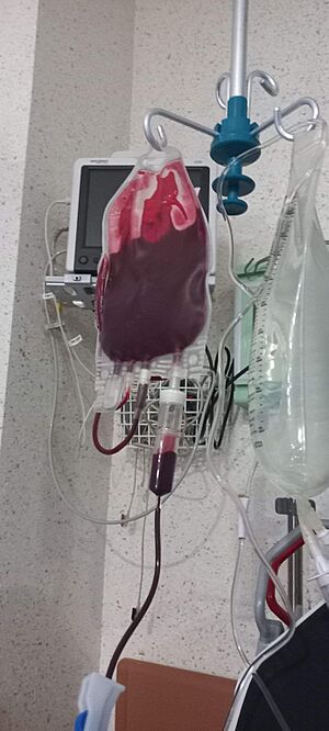 Archivo:Blood unit during transfusion