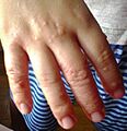 Dermatitis herpetiforme - mano derecha