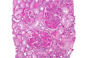 Archivo:Diffuse proliferative lupus nephritis - high mag