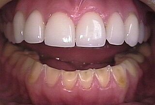 Oral Manifestation of Bulimia..jpg