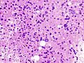 Hepatocellular carcinoma histopathology (1)