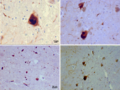 Lewy bodies (alpha synuclein inclusions)