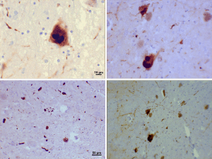 Archivo:Lewy bodies (alpha synuclein inclusions)