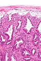 Ischemic colitis - high mag