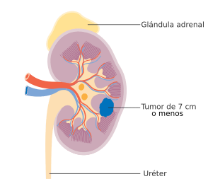 Diagram showing stage 1 kidney cancer CRUK 192-es