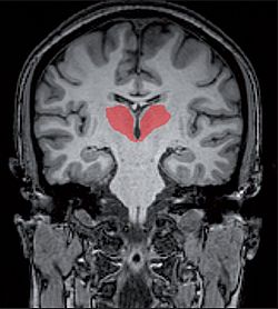 Archivo:Thalamus (marked in red) in coronal section