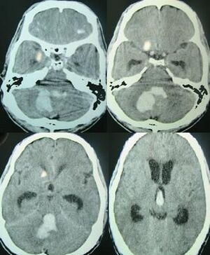 Archivo:Posterior fossa hemorrhage