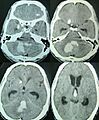 Posterior fossa hemorrhage