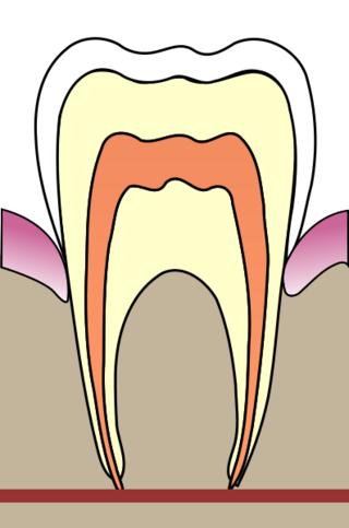 Cavities evolution 1.svg