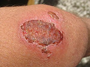 Archivo:Scab