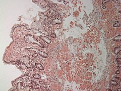 Small bowel duodenum with amyloid deposition congo red 10X