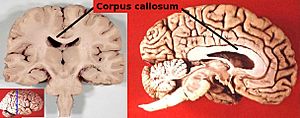 Archivo:Corpus callosum