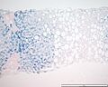 Hemochromatosis acini