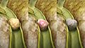 Types of Gallstones