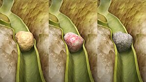 Archivo:Types of Gallstones