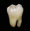 Lower wisdom tooth