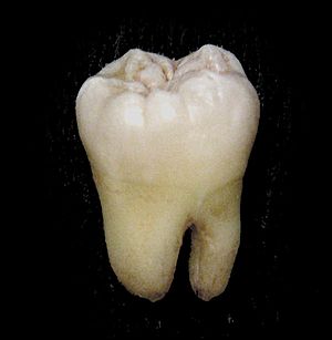 Archivo:Lower wisdom tooth
