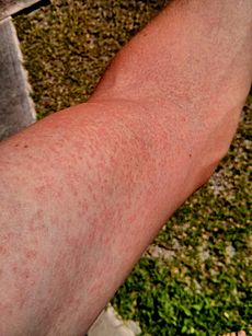 Archivo:Zika.Virus.Rash.Arm.2014