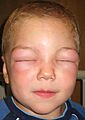 Angioedema2010