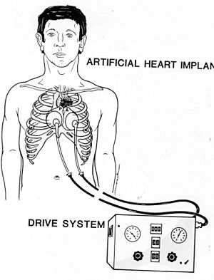 Archivo:Jarvik-7 Artificial Heart Image 3559-OT