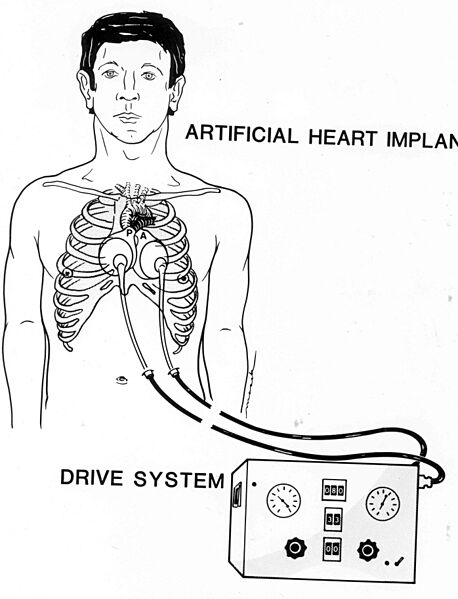Jarvik-7 Artificial Heart Image 3559-OT