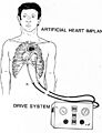 Jarvik-7 Artificial Heart Image 3559-OT