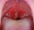 Streptococcal pharyngitis