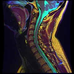 Archivo:08 Cervical MRI scan R T1WFSE G T2WfrFSE STIR B