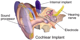 Cochlear Implant.png