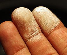 Archivo:Hydrogen peroxide 35 percent on skin