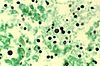 Cryptococcosis of lung in patient with AIDS Methenamine silver stain 963 lores.jpg