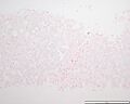 Hemochromatosis liver section