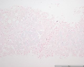 Hemochromatosis liver section.JPG