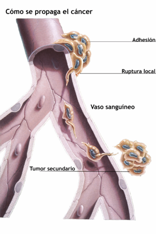 Metastasis illustration-es.png