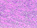 Myocardial infarct emmolition phase histopathology