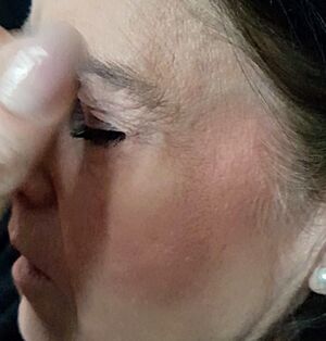 Archivo:Blushing cheeks is a common symptom during attacks of cluster headache