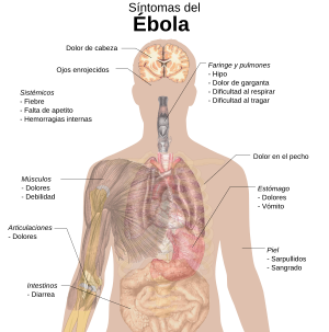Archivo:Symptoms of ebola (vector image)-es