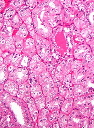 Archivo:Chromophobe renal cell carcinoma, eosinophilic variant - high mag