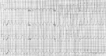 Electrocardiogram of Ventricular Tachycardia