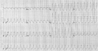 Electrocardiogram of Ventricular Tachycardia.png