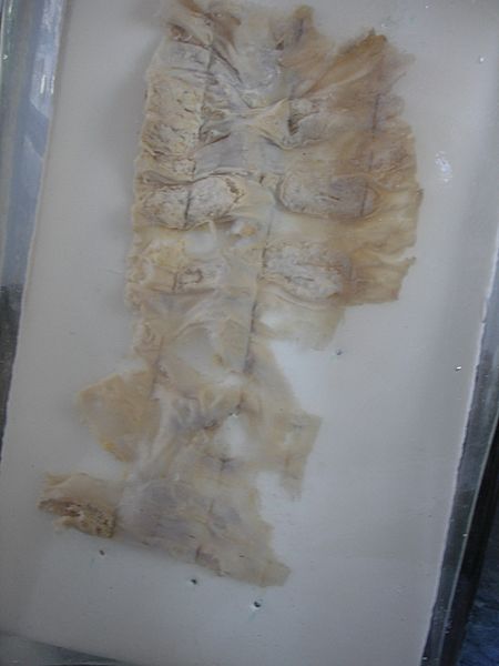Amoebic Ulcer Intestine