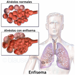 Archivo:Blausen 0343 Emphysema-es