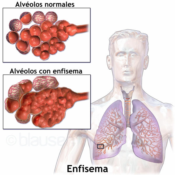 Blausen 0343 Emphysema-es