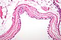 Bronchogenic cyst high mag