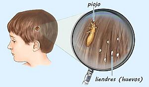 Archivo:Diferencia entre piojos y liendres