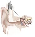 Cochlear implant