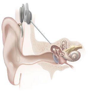 Archivo:Cochlear implant